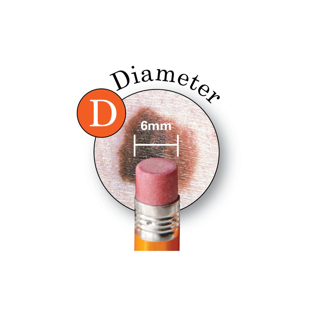 Use the ABCDEs of #melanoma as a guide when checking your skin. If you see anything changing, itching or bleeding on your skin, make an appointment to see a board-certified dermatologist. bit.ly/26B7dsA