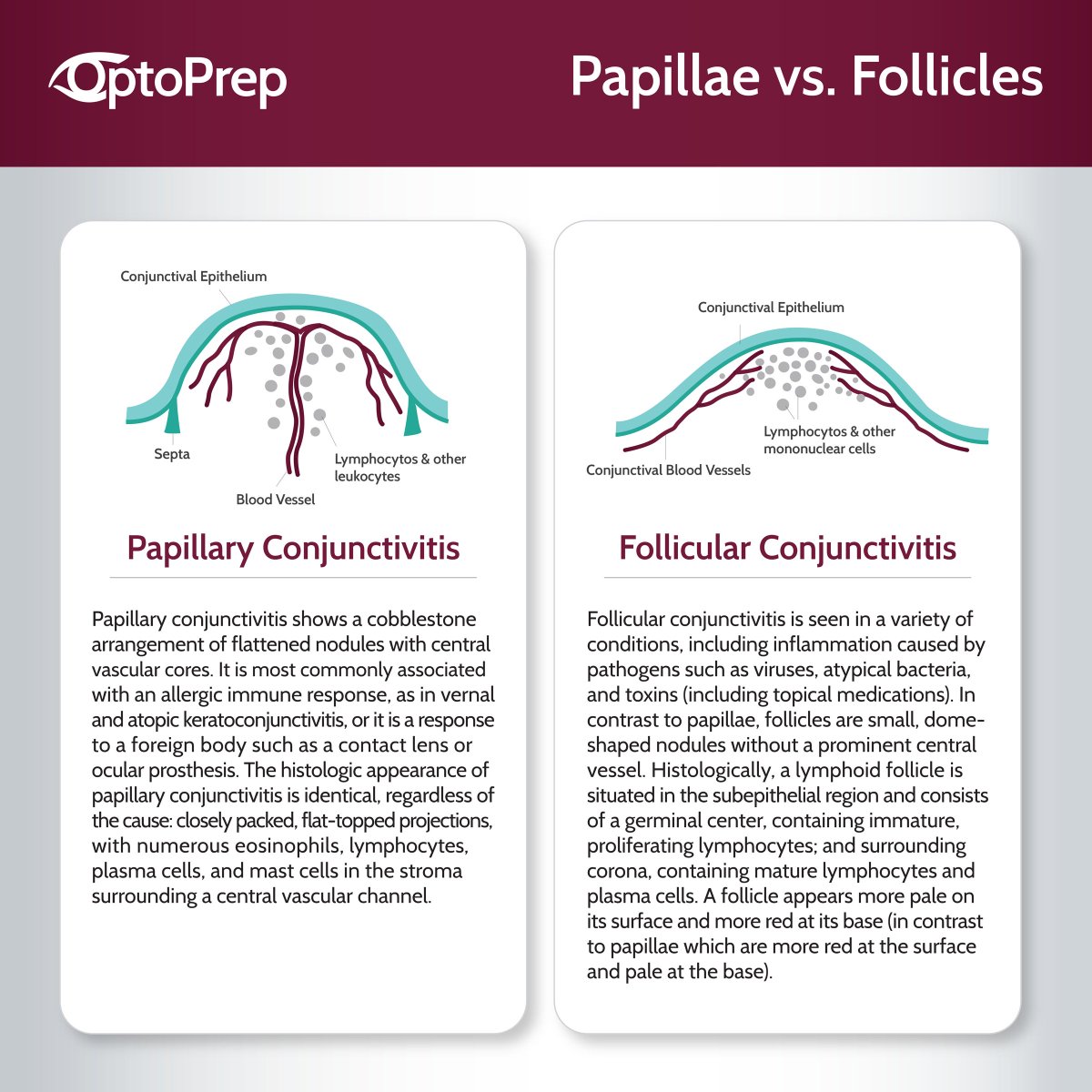 Optoprep Papillary vs. Follicular Conjunctivitis #Papilae vs. #Follicles # ...