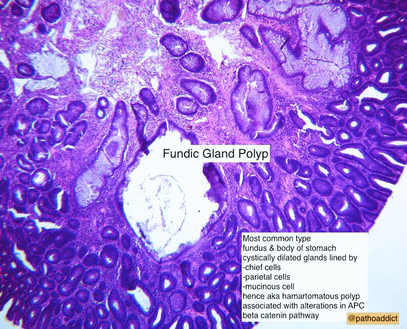 DrAppyNI's tweet photo. #highyield #pathoaddicts #gastric #polyp #fundic #histopath #surgical https://t.co/0ElMiwBezW