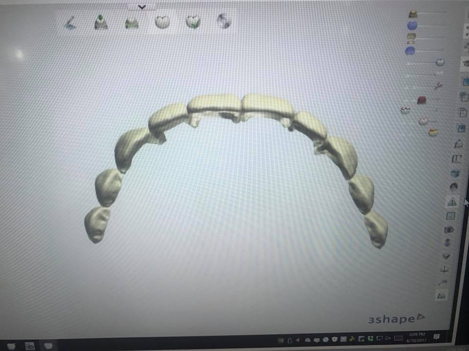 Argen_Corp's tweet photo. We love digital technology! Thanks for sharing, Frank Escalante of Newport Beach Smile Designs. #ArgenDigital #MilledWax #DentalTech #DentalLab https://t.co/g8LW41mhIJ