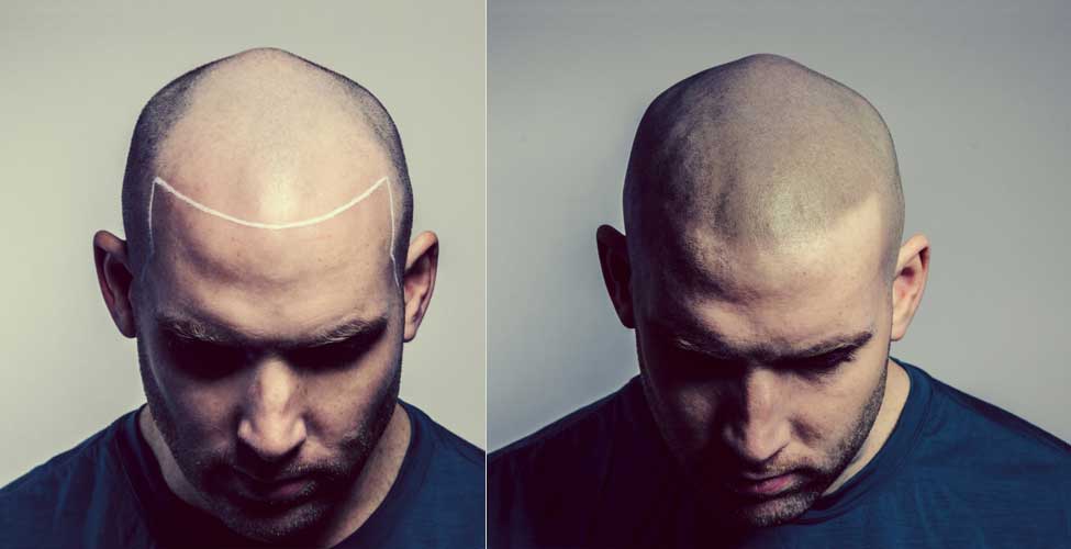 MuslimBreak's tweet image. Does Islam allow hair tattoos to replace hair loss? dlvr.it/Q4QsKX