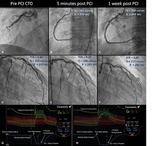 Eurointervention Auf Twitter Recovery Of Absolute Coronary Flow And Resistance 1 Week After Pci Of A Chronic Total Occluded Coronary Artery Using The Novel Rayflow C Infusion Catheter T Co Ms9saoxw18 T Co Y0rfxhhhbf