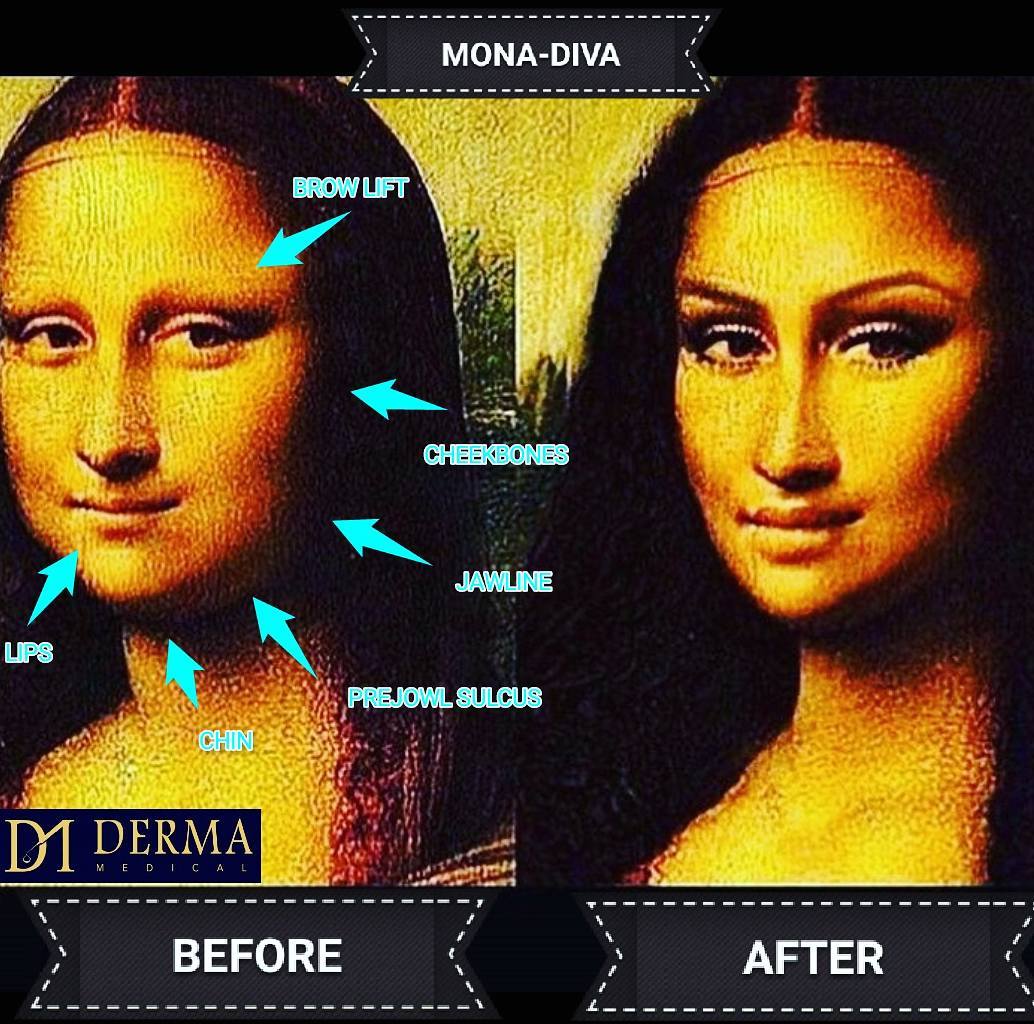 DermaMedicalUK's tweet photo. Before and after nonsurgical contouring 💉
~~~~~~~~~~~~~~~~~~~~~~~~~~~
#botox #fillers #cosmetics #makeup #beauty #attractive #derma_medical #doctor #dentist #nurse #midwife #pharmacist #surgeon #gp #cosmeticdoctor #AestheticEye #Beautification #artist #art https://t.co/n99D0dkF4i