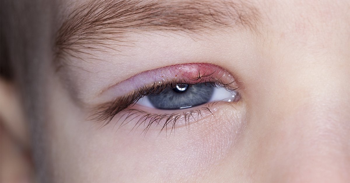 how to get rid of a stye how to get rid of a stye
