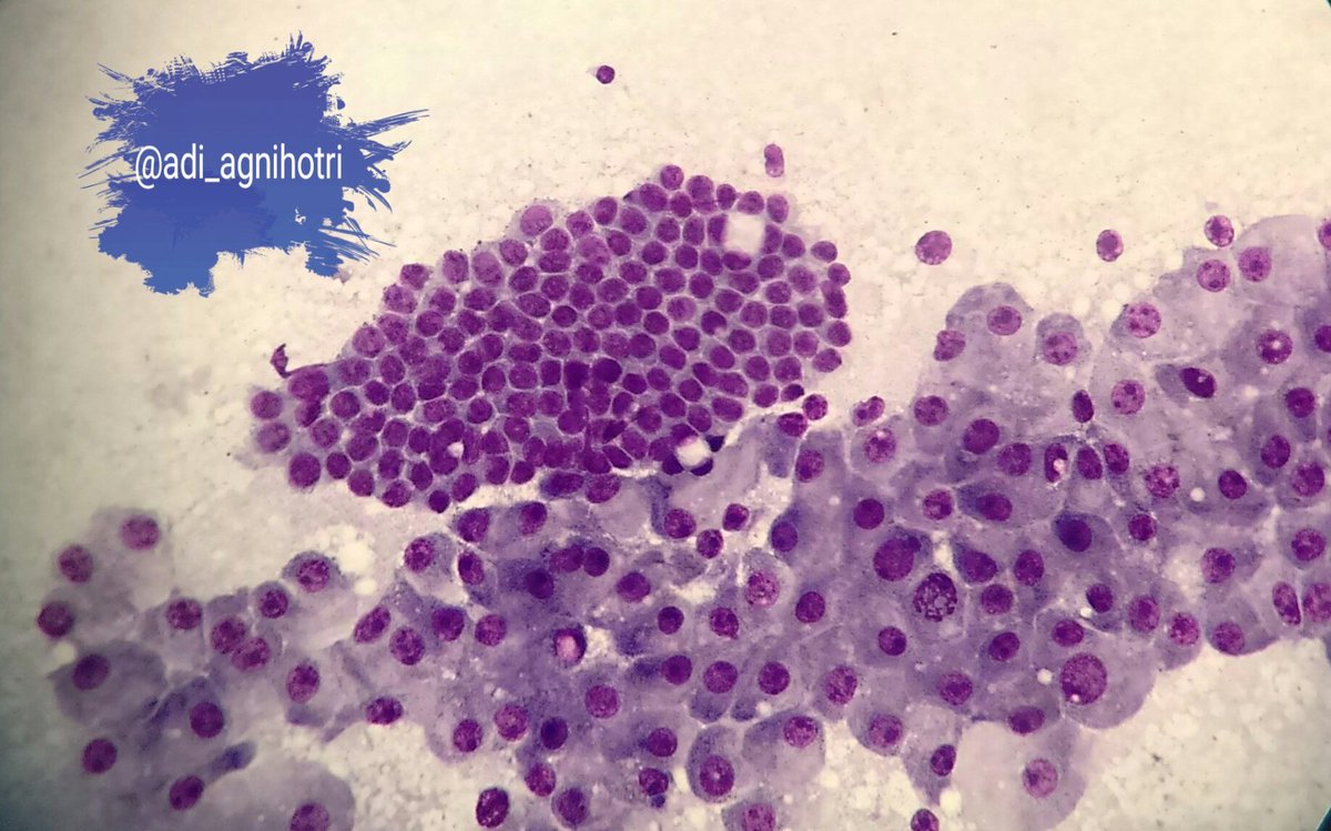 adi_agnihotri's tweet photo. Fibroadenoma with fibrocystic change. #Apocrine metaplasia #BreastCytology @eurocytology
@VijayPatho @suraksharaob @DraEosina @GeronimoJrLapac @JMGardnerMD @SGottesmanMD @smlungpathguy @Sara_Jiang @_SaranyaS_ https://t.co/4czdZYWLuB