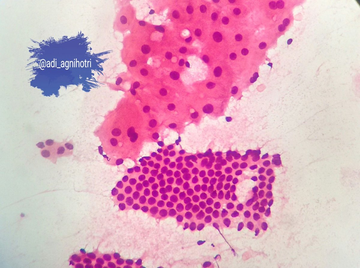 adi_agnihotri's tweet photo. Fibroadenoma with fibrocystic change. #Apocrine metaplasia #BreastCytology @eurocytology
@VijayPatho @suraksharaob @DraEosina @GeronimoJrLapac @JMGardnerMD @SGottesmanMD @smlungpathguy @Sara_Jiang @_SaranyaS_ https://t.co/4czdZYWLuB