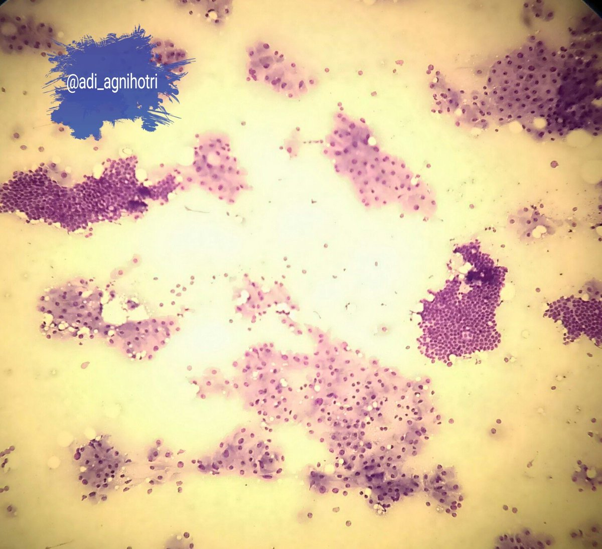 adi_agnihotri's tweet photo. Fibroadenoma with fibrocystic change. #Apocrine metaplasia #BreastCytology @eurocytology
@VijayPatho @suraksharaob @DraEosina @GeronimoJrLapac @JMGardnerMD @SGottesmanMD @smlungpathguy @Sara_Jiang @_SaranyaS_ https://t.co/4czdZYWLuB