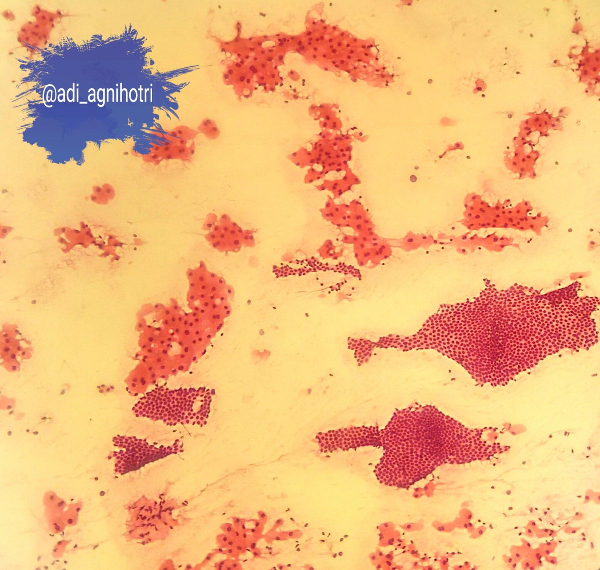 adi_agnihotri's tweet photo. Fibroadenoma with fibrocystic change. #Apocrine metaplasia #BreastCytology @eurocytology
@VijayPatho @suraksharaob @DraEosina @GeronimoJrLapac @JMGardnerMD @SGottesmanMD @smlungpathguy @Sara_Jiang @_SaranyaS_ https://t.co/4czdZYWLuB