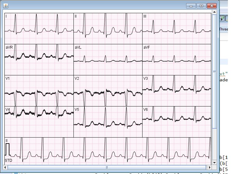 epsilon_iot's tweet image. 12 Lead ECG Data from our Designed wireless ECG System. More refinement to come soon...