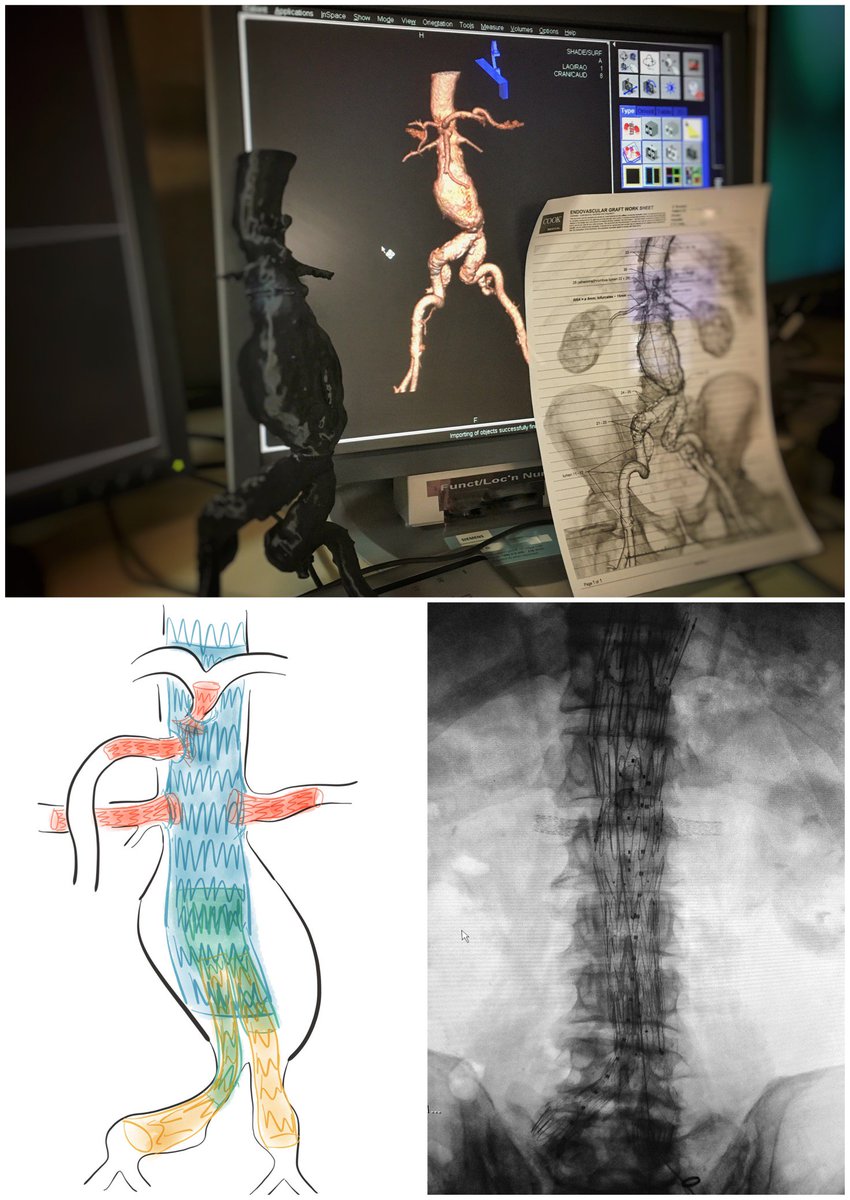 ozvascdoc's tweet photo. Kitted out with #3dSpin CT, #FusionImaging &amp; #LowDose imaging, our brand-new @SiemensHealth Ceiling-Mounted #ArtisZee will help us perform more world-leading, complex #Vascular &amp; #EndovascularSurgery at @Austin_Health – saving lives and limbs for our patients! @anzsvs https://t.co/deHLvyg8eP