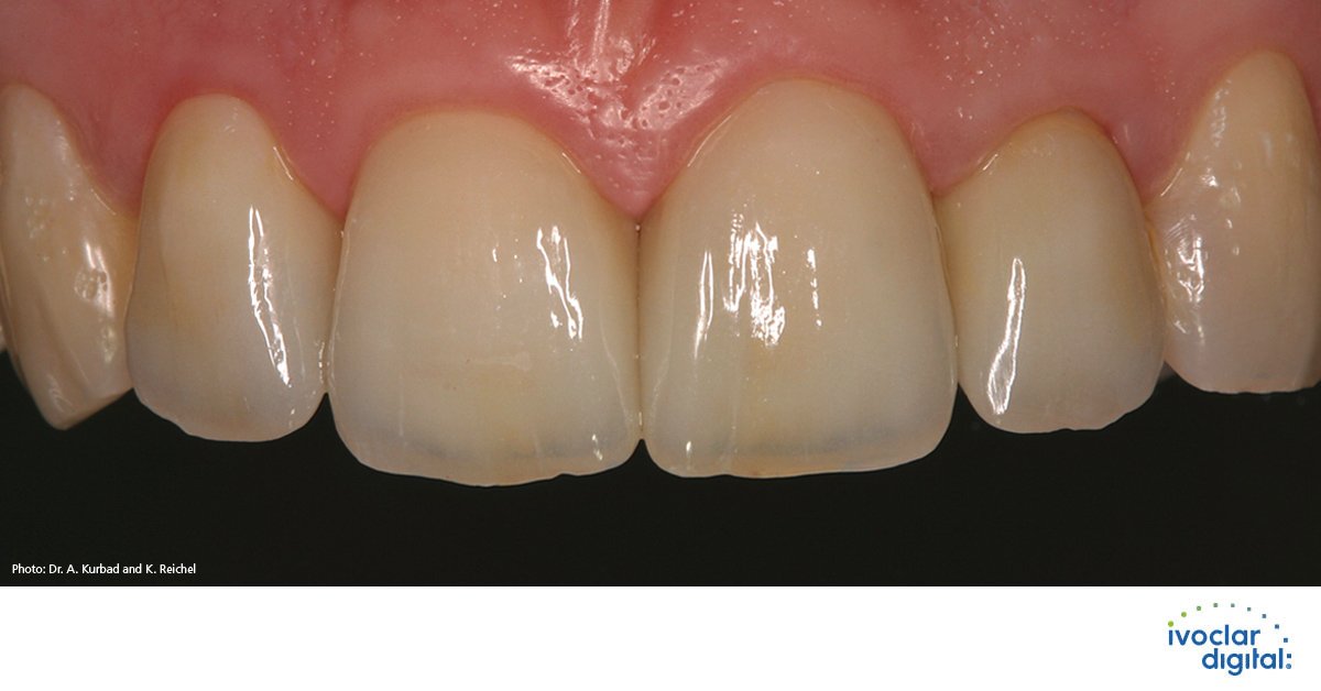 IPS e.max CAD: Impressive esthetics. Maximum reliability. bit.ly/2hBSV7t #Ivoclardigital #IPSemaxCAD #lithiumdisilicate