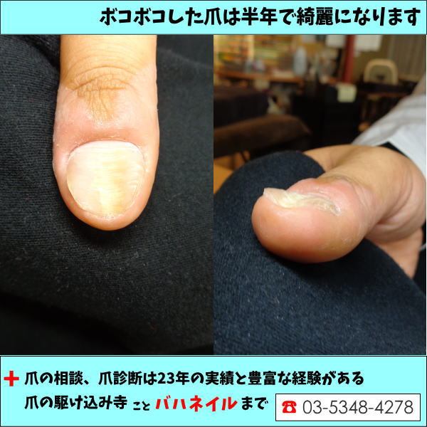 爪の駆け込み寺ことバハネイル 一年後の爪の状態 遠方からのご来店 遠方 その後 爪 ボコボコ へこみ ネイルケア 矯正 年末年始 T Co Nxitleelui T Co Mb6l6bydqi Twitter
