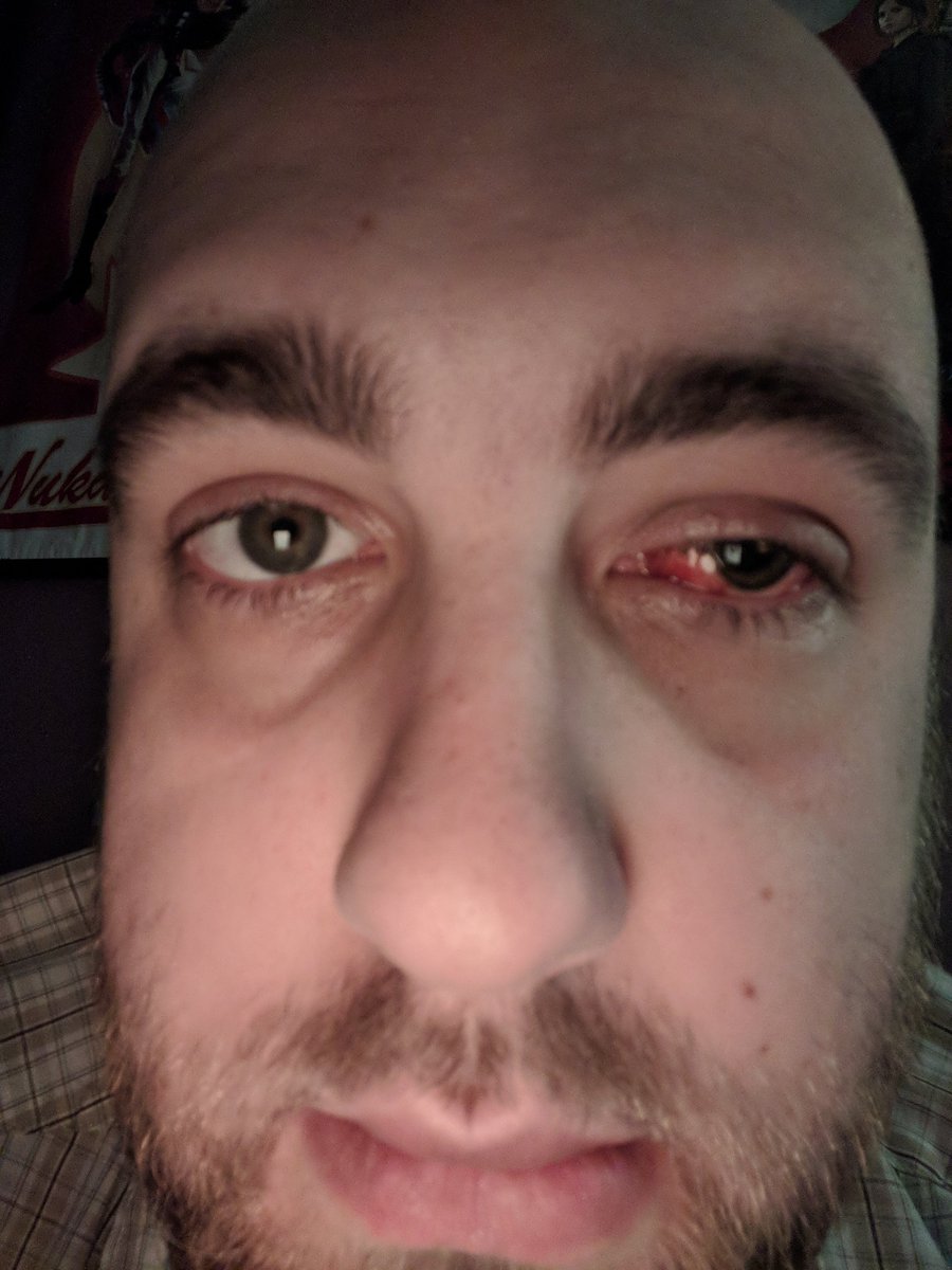 Castleforge's tweet photo. Retinal surgery. Can't see. Will be back in a few weeks. This sucks https://t.co/LhhkmVUNWz