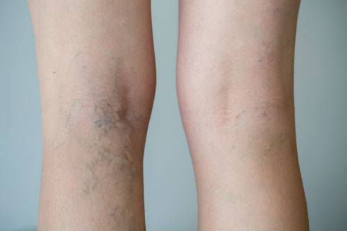 InfiniteSkinFL's tweet photo. If you suffer from Varicose veins, Spider veins or Chronic Venous Insufficiency we have several options to treat your vein problems. Call us today! 954-357-1515 #infiniteskinandlaser #skincare #veinproblems https://t.co/WlHO9xoJPf