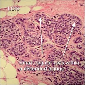 What is Lobular Carcinoma In-Situ?  Let Moose & Doc explain ...
breast-cancer.ca/lobcis/
#lobularcarcinomainsitu
#breastcancer