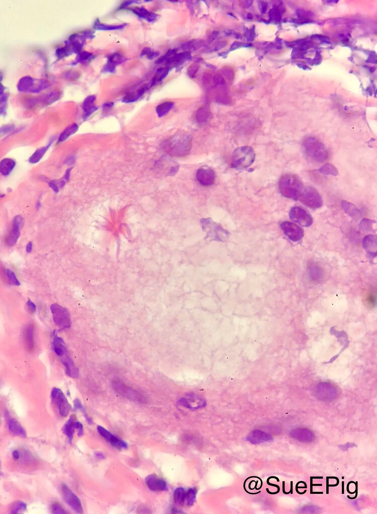 SueEPig's tweet photo. @DrAldehyde @BinXu16 @smlungpathguy @JMGardnerMD @kriyer68 @Sara_Jiang @DrFNA @bansar_bansaria @VijayPatho #asteroidbody https://t.co/h0id0HL4Sr