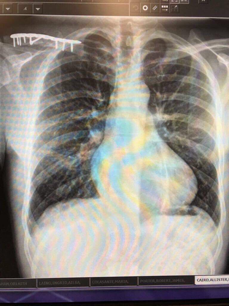 rspns04's tweet photo. Hi @alcaird pfff what a hard crash!! Join us in wishing Allister a speedy recovery! Thanks for the Pictures by @koruptvision #goodhealth https://t.co/BD94kwVW4h
