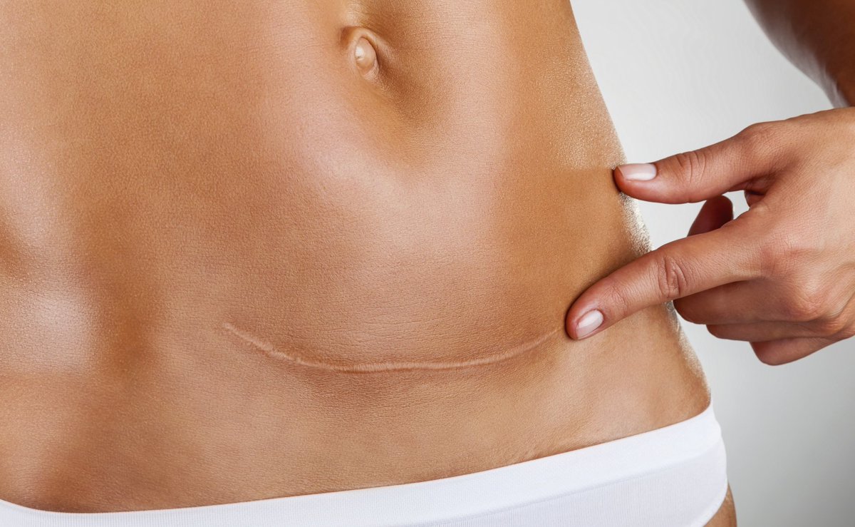 Benefits of Scar Massage: Minimizes the appearance of scars. Addresses internal adhesions and overgrowth of scar tissue. Evens out color and surface appearance. Increases sensation to a numb area. Reduces pulling and itching at the site of the scar. Make an appointment call today