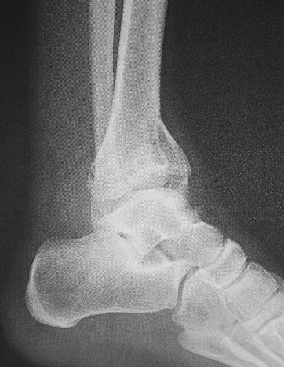 sportsfootankle's tweet photo. #Pilonfractures occur at the lower end of the #tibia and involve the weight-bearing surface of the #ankle joint https://t.co/RgqjeHe0jm https://t.co/8ZFs4PQ4fg