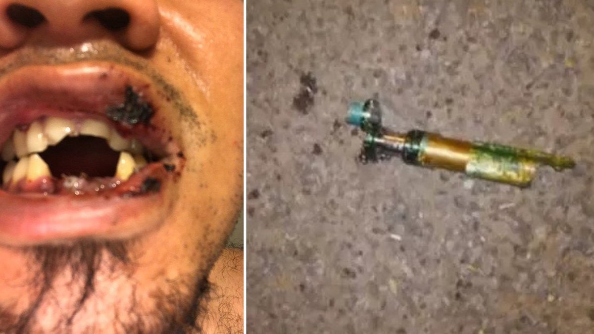 Man suffers severe injuries after e-cigarette explodes in mouth bit.ly/2ADGT6I?utm_so… https://t.co/RfAJrIGx0N