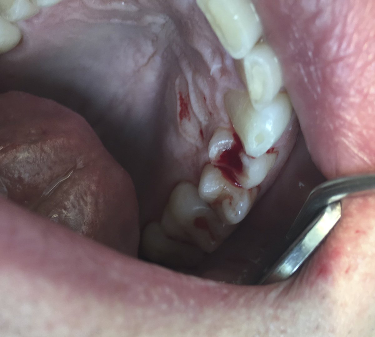 rangefound's tweet photo. @larabar You cracked my tooth with what ext. 42275 identified as a "Date Pit".  Root canal = $1500. Sent in all documentation back 2 years of dental records. You offered $250. Really? https://t.co/OeSwR03Ga8