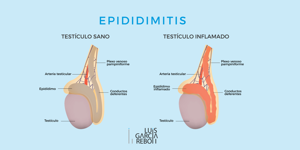 Cara Mengobati Epididimitis Cl铆nica Garc铆aReboll on Twitter: "La #epididimitis es la inflamaci贸n
