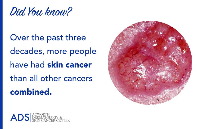 Over the past three decades, more people have had skin cancer than all other cancers combined. #skincancer