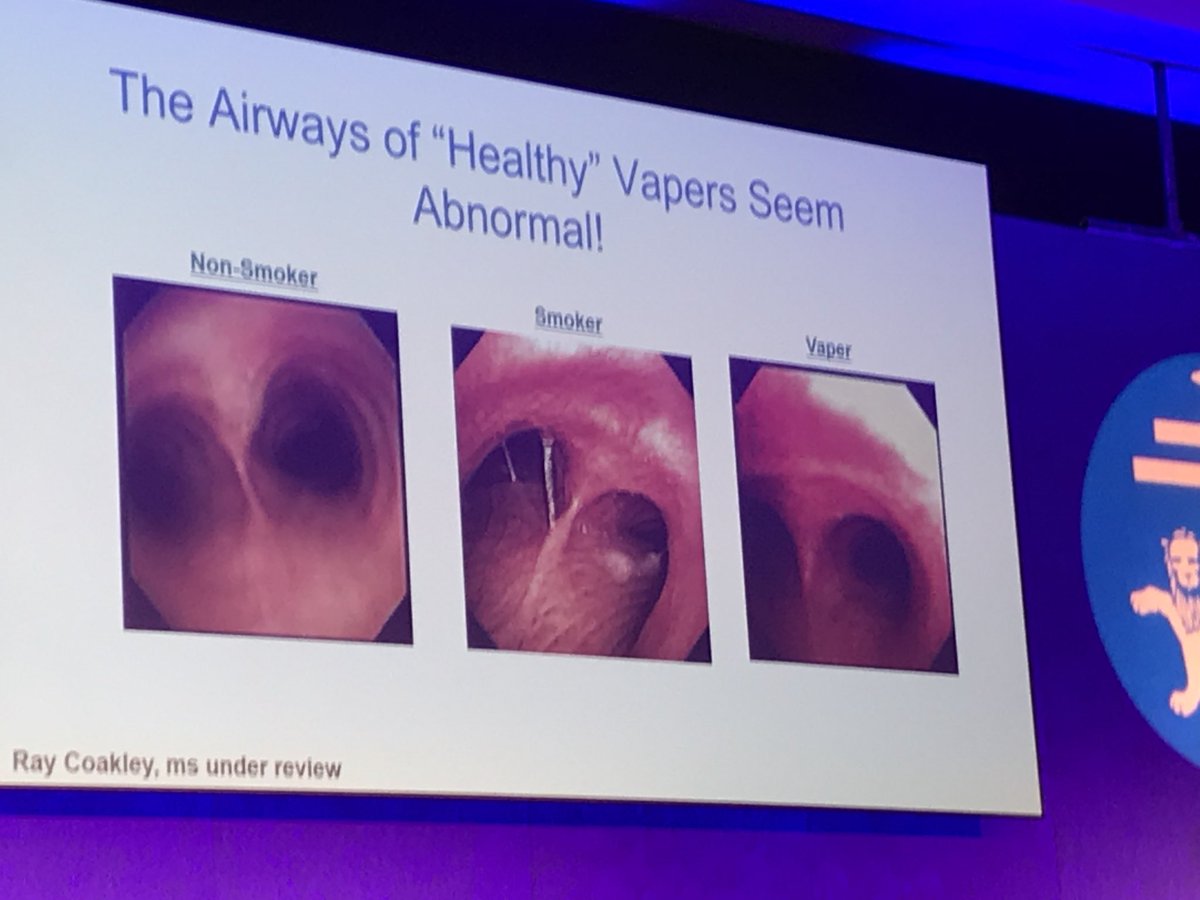 hsbalata's tweet photo. Bronchial airways appear ‘a bit red and funny looking’ in Vapers vs non-smokers. We don’t understand why yet but as my lovely (non-medically trained) mother will often say...”that can’t be good!!” #BTSWinter2017 https://t.co/4ZZgYIs0mb
