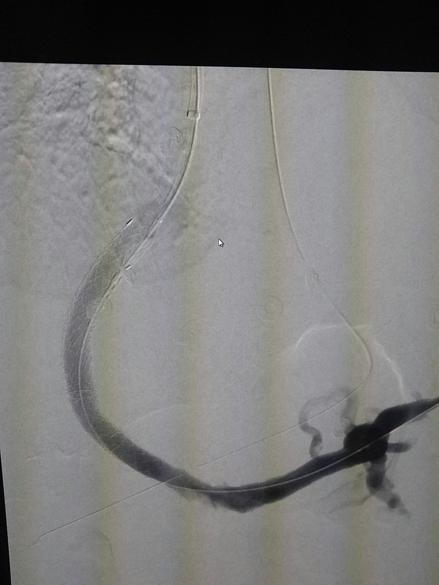 PVR TIPS, nice look at the small fibrotic native main in first pic.  <a href="/NorthwesternIR/">NorthwesternIR</a>