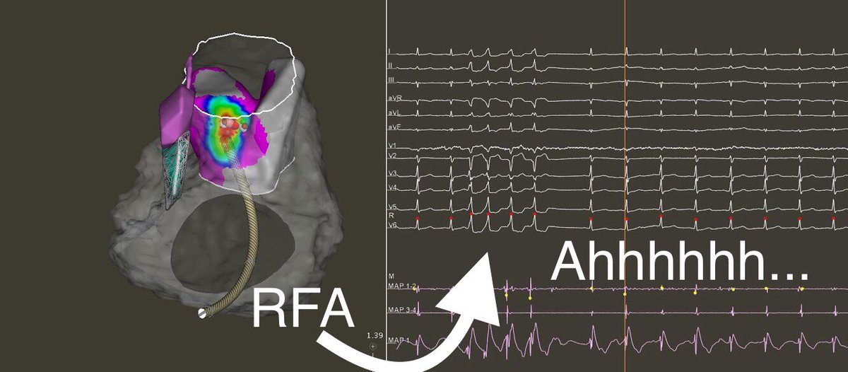 GrupposoVito's tweet image. PVC originating from posterior septal region of RVOT. Nothing more satisfying then seeing them disappear right before your eyes.... #MapMoreBurnless #PVC