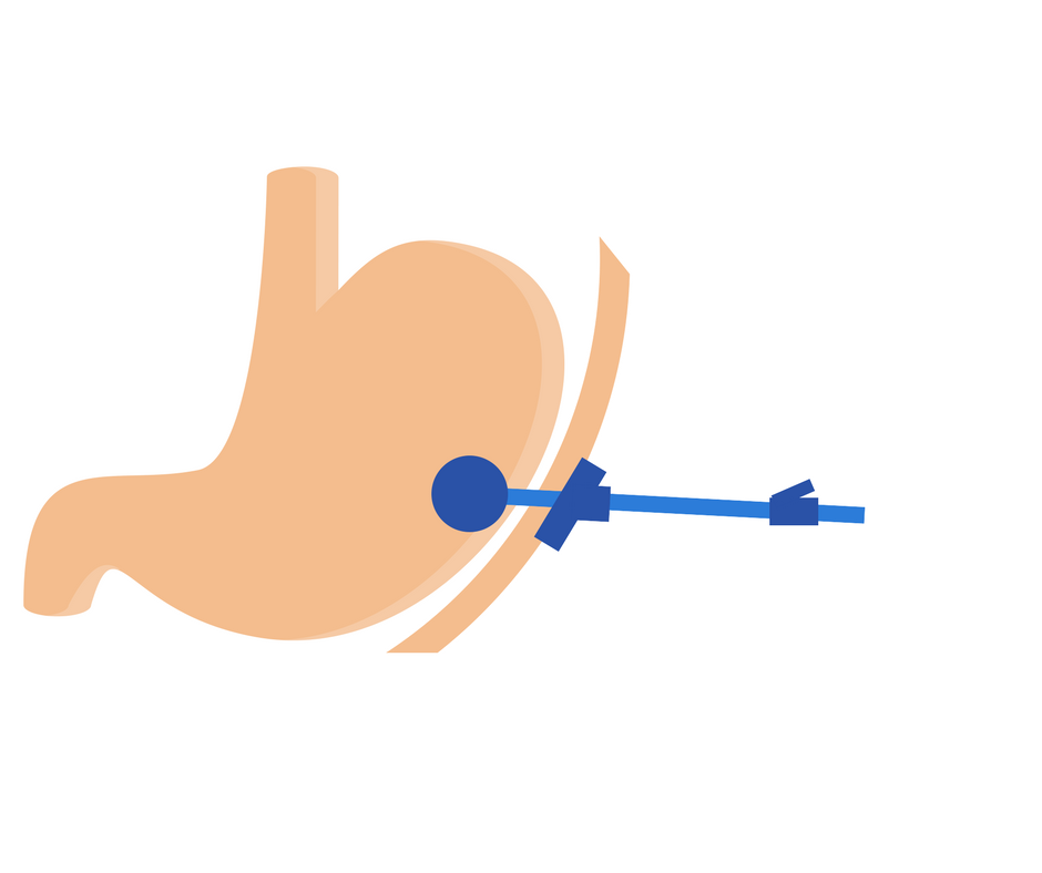 Een nieuw artikel op onze website! "Verzorging PEG-sonde dagelijkse kost?" think4nurses.be/peg-sonde.html #verpleegkunde #BEnurse #Think4Nurses #PEG #Sonde #Verzorging