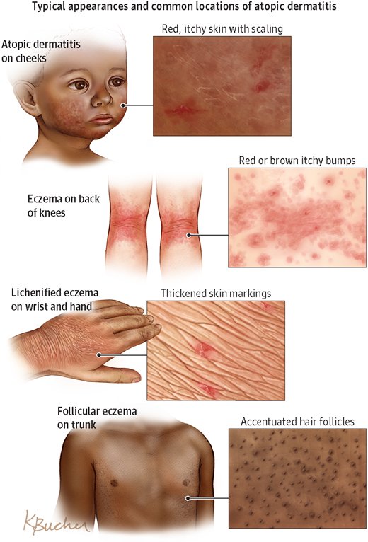 Effects of Probiotics on Pediatric Atopic Dermatitis ja.ma/2BD739I