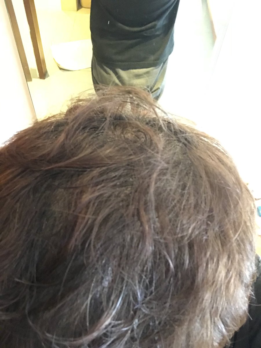 えんどうりょういち Pa Twitter 我流aga治療 11週目の記録 いつもリアップ塗ったあとに撮ってるんですけど だんだん目立たなくなってきた 頭を触ると 基本猫っ毛というか コシがない細い髪の毛なんで 毛量があまり感じないけど 見た目はボリュームがあって