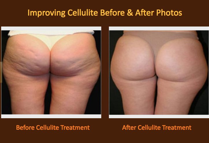 Cultura On Twitter Cellulite Reduction In Washington Dc Https