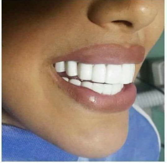 En el infierno hay un lugar reservado para los odontólogos que le dejan los dientes de Chiclets Adams a sus pacientes.