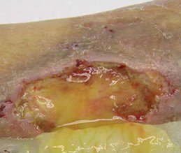 Coloplast_WCare's tweet photo. Did you know that… Chronic wound fluid causes breakdown of protein and growth factors, which prolongs inflammation and inhibits cell proliferation to delay healing? https://t.co/tAxxeJcohK