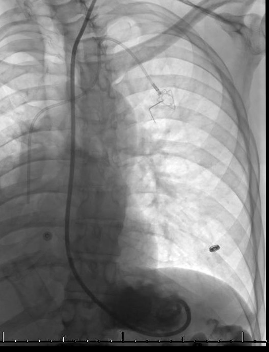 Frozen abdomen, peritoneal carcinomatosis, no window.  Transesophageal G tube for #palliation.  NG out.  
ncbi.nlm.nih.gov/pubmed/20152318