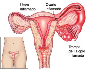 Resultado de imagen para ooforitis