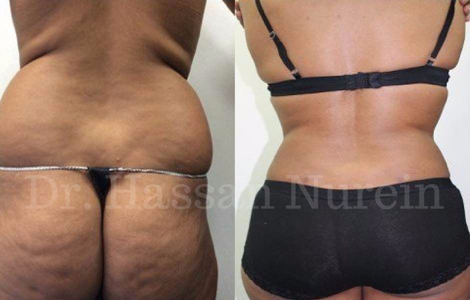 #VaserLiposuction before and after results with Dr. Nurein. Contact us to book a consultation at any of our clinics in 3London, #Sheffield, #Manchester or #Liverpool. Call 0800 776 5689.