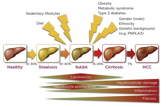 Soc_Endo's tweet photo. Fat accumulation and non-alcoholic steatohepatitis (NASH). Read more in The #Endocrinologist. https://t.co/Xgr9RBxUJm https://t.co/M1jf752sg3