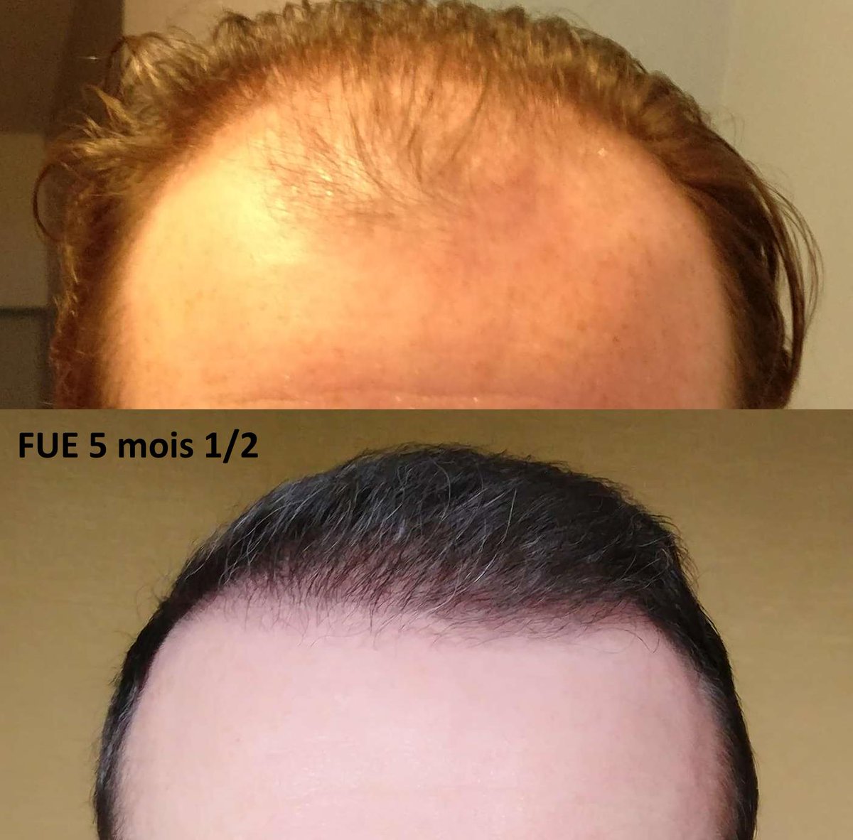 Photos 5 mois 1/2 après ma greffe de cheveux FUE par <a href="/DrJeanDevroye/">HTS Clinic</a> : nouvelle ligne frontale au top ! bien-etre-sante.info/photos-5-mois-…