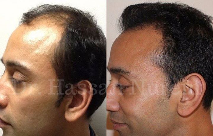 #HairTransplant Results - Book a Free #Hair Consultation Online Here: bit.ly/2ARTnab