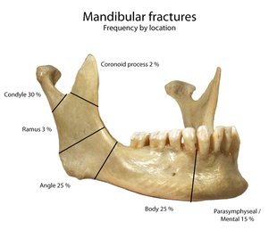 What are the differences in Pediatric Mandible Fractures?…ic-reconstructive-surgery.imedpub.com/what-are-the-d…