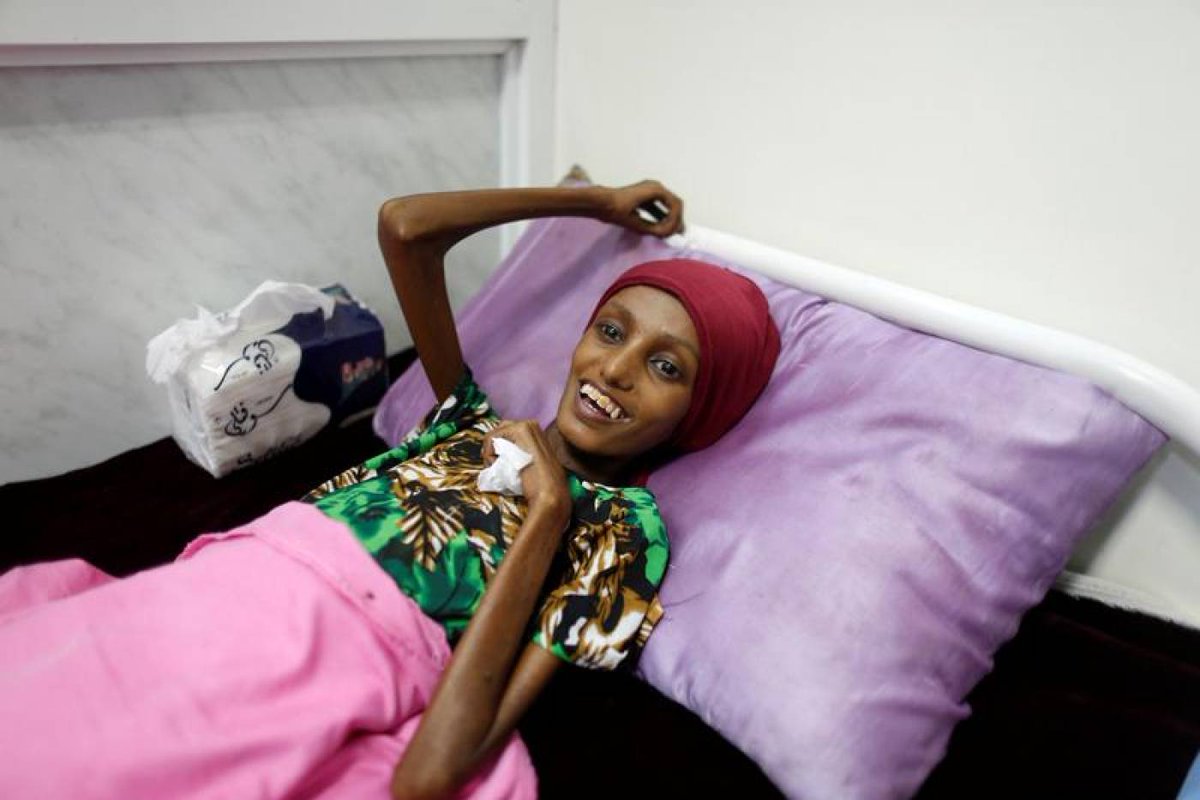 dignity_EQ's tweet photo. Saida Ahmad Baghili, 18, who has been affected by severe malnutrition, rests on a bed at the al-Thawra hospital in the Red Sea port... December 08, 2016 03:16pm EST. REUTERS https://t.co/o9EUaE8Eq3