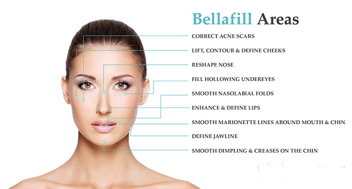 midwestaging's tweet image. #Bellafill can be used for so much more than acne scars and smile lines! Both Dr. Asadullah and Dr. Akbar are leading injectors for Bellafill. 
#dermalfillers #MedSpa
Feel Free to Call Now: (815) 277-5229 OR
For further info: goo.gl/zTEz2H