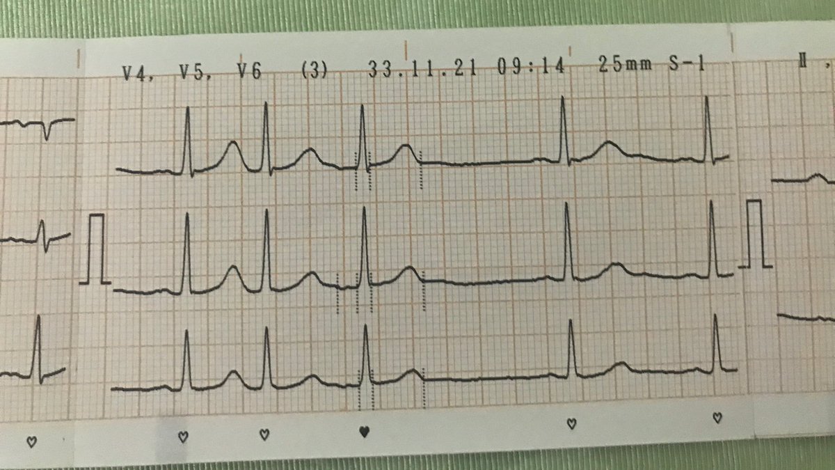 TwindaRarasati's tweet photo. Pasien lansia dtg dgn hasil EKG nya gini. (Lead V1-V3 ngga kefoto ✌🏻)

👩🏻: pak, kalo dari hasil rekam jantungnya, bapak ada sakit jantungnya nih
👴🏻: gpp dok. Yg penting bukan jantung hati saya yg sakit #cengenges
👩🏻: ... 😅 #dokternyaygjantungan https://t.co/WKgiQQuiqa