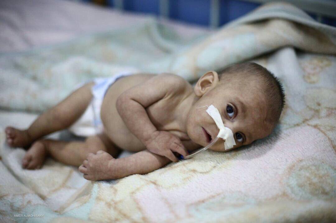 MhdKatoub's tweet photo. This is Hussien a 9 months boy.
Hussien was screened by the UN delegation 20 days ago in besieged #Ghouta. The UN only screened him and did nothing.
Hussien passed away this morning.
There are thousands of children who need help in #Ghouta , you should act now #BreakGhoutaSiege https://t.co/ccCoGAsjLH