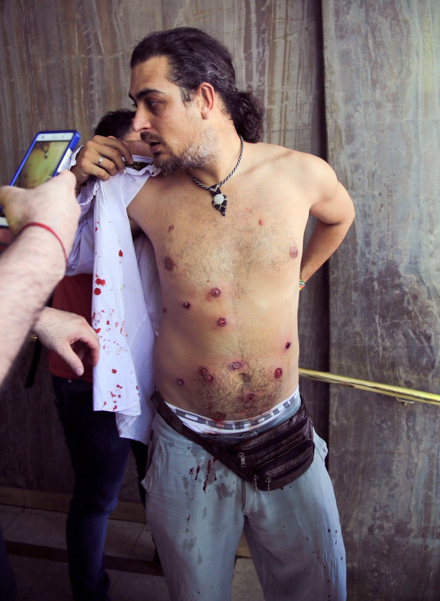 SebasAbrevaya's tweet photo. @pagina12 Otra imagen de las heridas de bala que sufrió Pablo Piovano, fotógrafo premiado internacionalmente por su trabajo sobre las consecuencias de los agrotóxicos en Argentina. https://t.co/YjxxZPnj3U