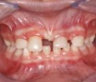 DentistryIQ's tweet photo. Today's @PI_Advisory - A new noninvasive flap technique for soft-tissue #grafting https://t.co/wnV5P4qopQ #dental #dentistry #ectodermal #dysplasia #AO18LA #gingival #recession https://t.co/LB9S3fhkF0