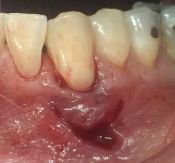 DentistryIQ's tweet photo. Today's @PI_Advisory - A new noninvasive flap technique for soft-tissue #grafting https://t.co/wnV5P4qopQ #dental #dentistry #ectodermal #dysplasia #AO18LA #gingival #recession https://t.co/LB9S3fhkF0